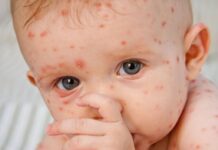 Более 90 случаев кори зарегистрировали в Ростовской области